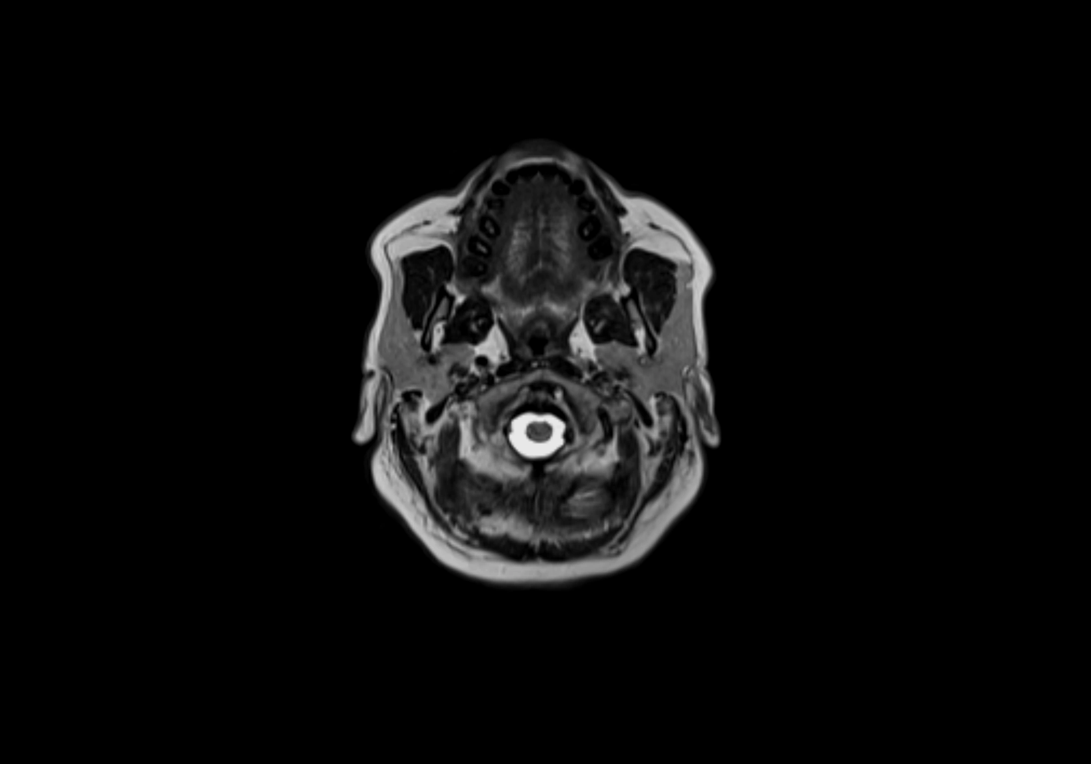 Neck axial  lymph node cross sectional MRI anatomy 3T MRI  image-img-00001-00030.webp